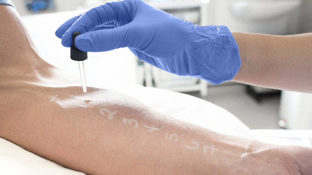 Does Medicare Cover Allergy Testing?